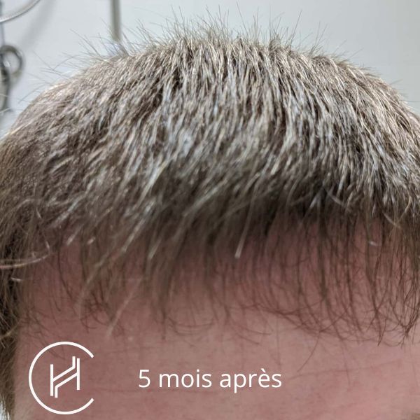 Greffe de cheveux 5 mois après