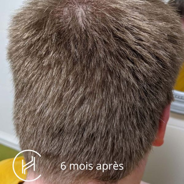 Greffe de cheveux 6 mois après (2)