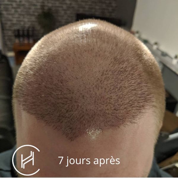 Greffe de cheveux 7 jours après