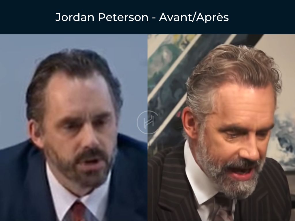 Jordan Peterson - Greffe de cheveux avant après