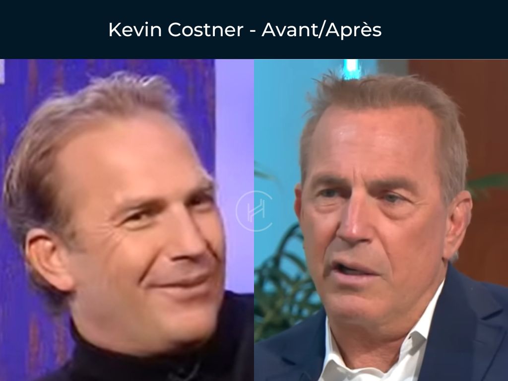 Kevin Costner - Greffe de cheveux avant après Kevin Costner - Greffe de cheveux avant après