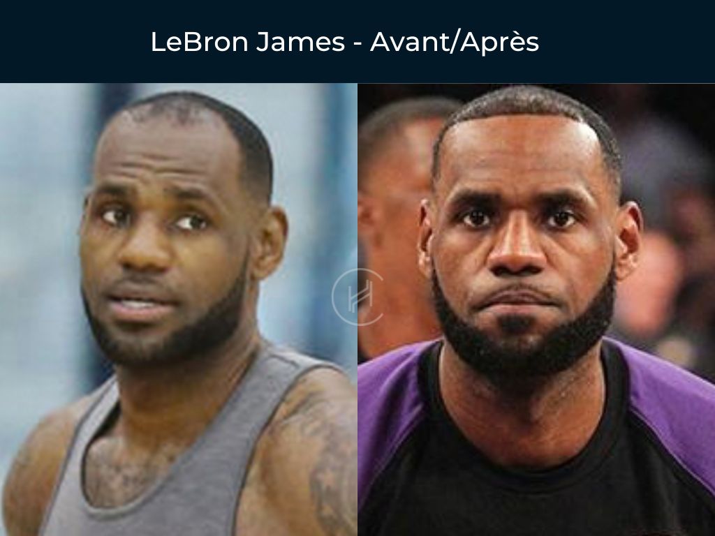 LeBron James - Greffe de cheveux avant après