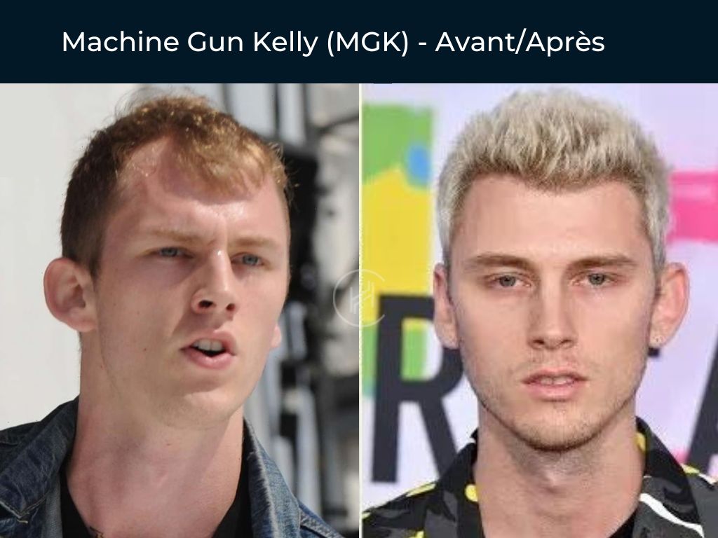Machine Gun Kelly (MGK) - Greffe de cheveux avant après