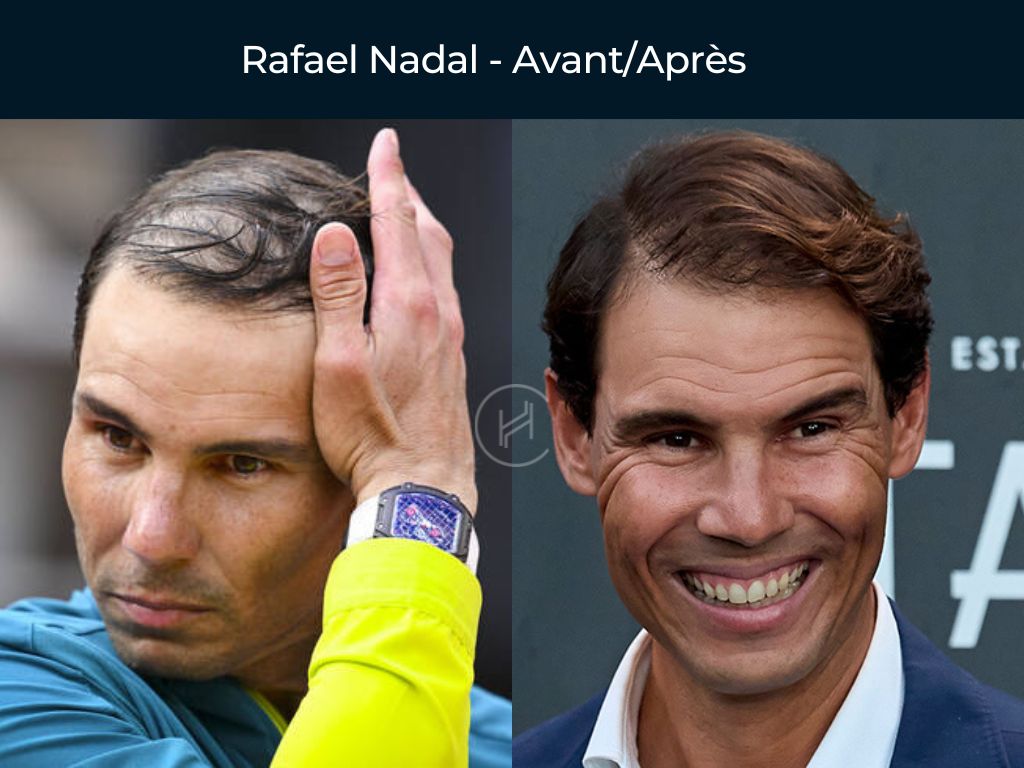 Rafael Nadal - Greffe de cheveux avant après
