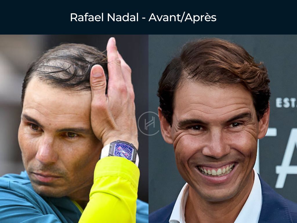 Rafael Nadal - Greffe de cheveux avant après Rafael Nadal - Greffe de cheveux avant après