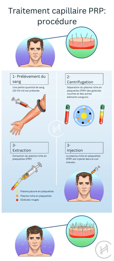 Traitement capillaire PRP procédure étapes