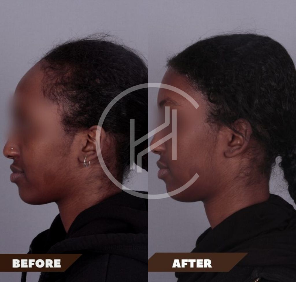 Chirurgie de réduction frontale avant et après vue latérale