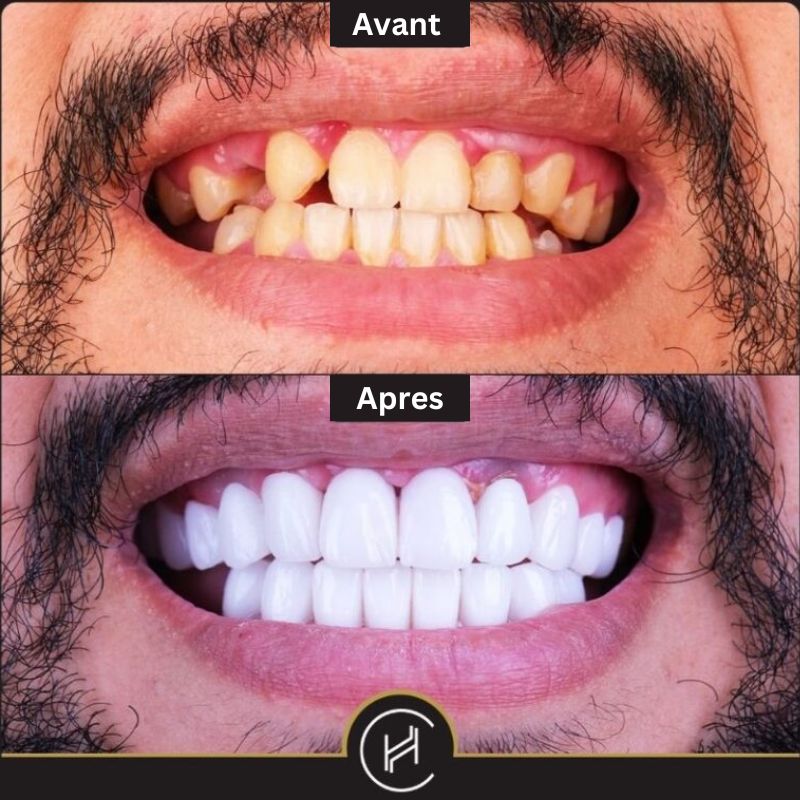 Implant dentaire en Turquie avant & après