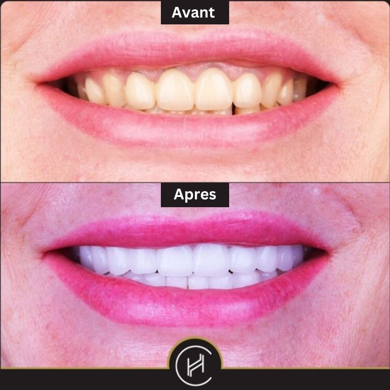 Couronnes dentaire : Avant - Après, résultats après la pose