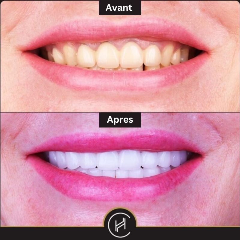 facette dentaire et blanchiment des dents avant apres a la clinique heva