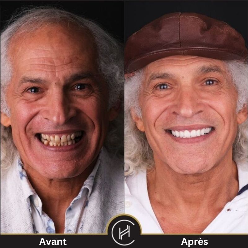 hollywood smile traitement dentaire homme avant après heva