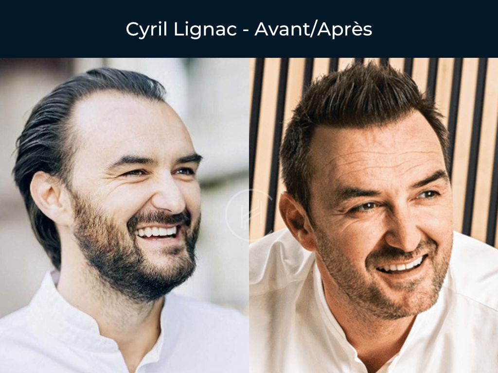 Cyril Lignac Greffe de cheveux avant apres