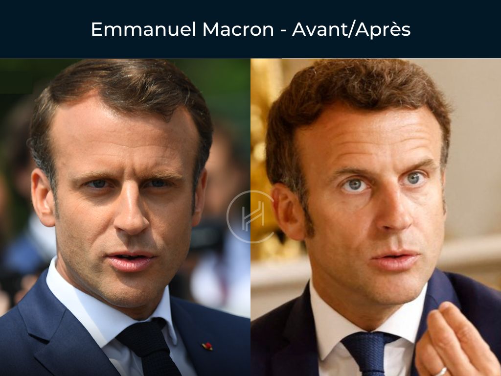 Emmanuel Macron Greffe de cheveux avant apres