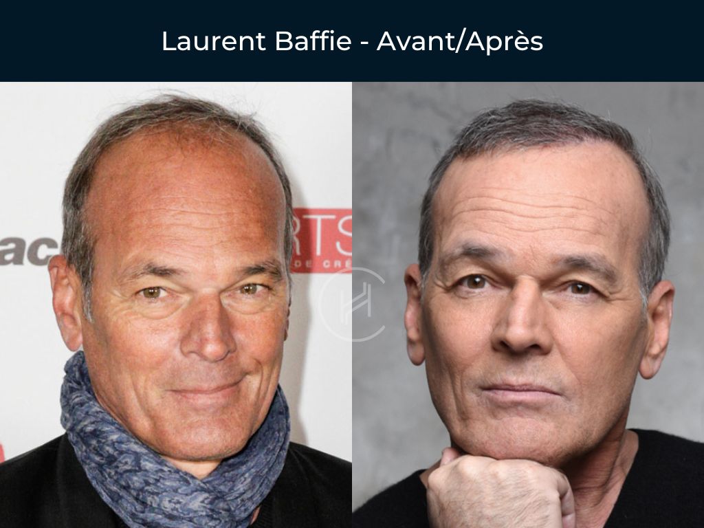 Laurent Baffie Greffe de cheveux avant apres