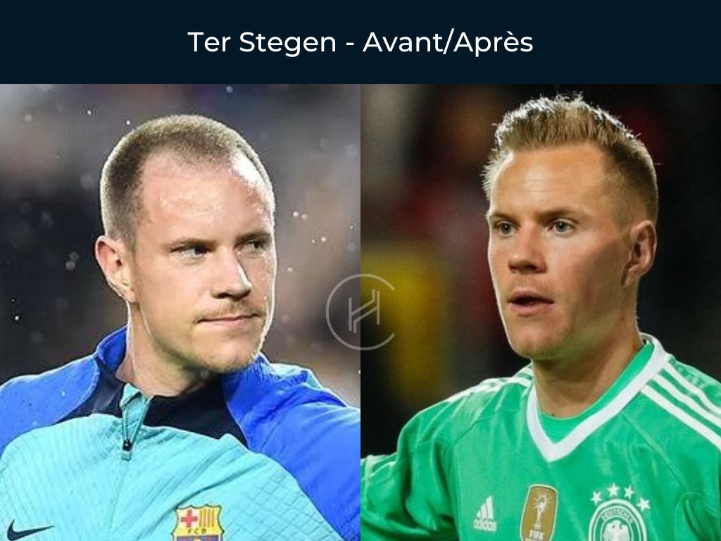 Ter Stegen Greffe de cheveux avant apres