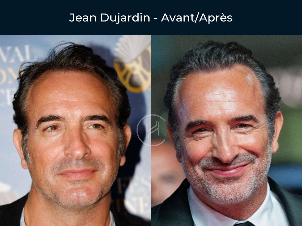 Jean Dujardin - Greffe de cheveux avant apres