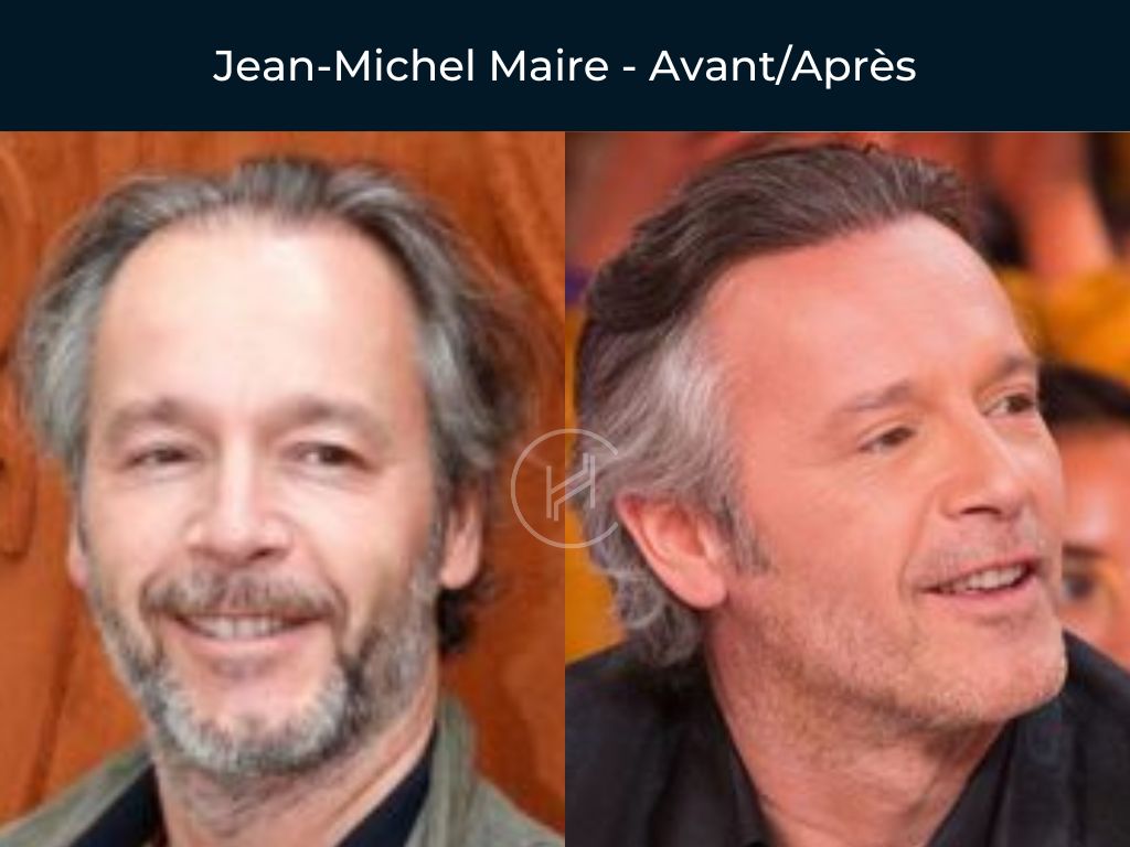 Jean-Michel Maire - Greffe de cheveux avant apres