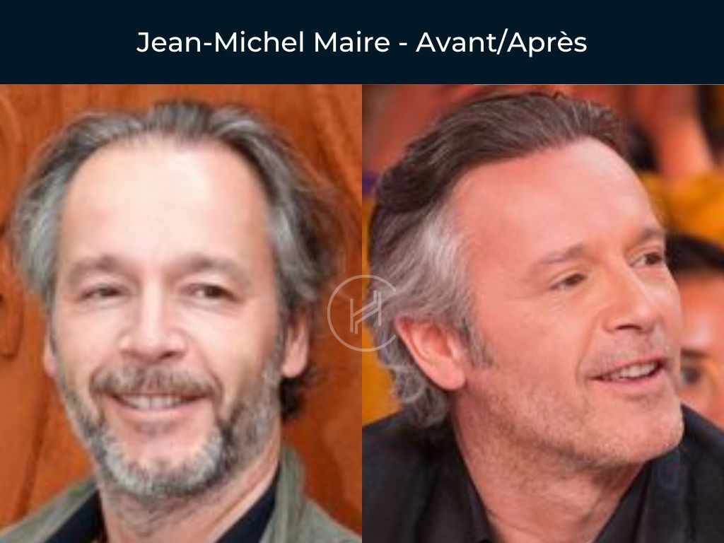 Jean-Michel Maire-Greffe-de-cheveux-avant-apres Jean-Michel Maire - Greffe de cheveux avant apres