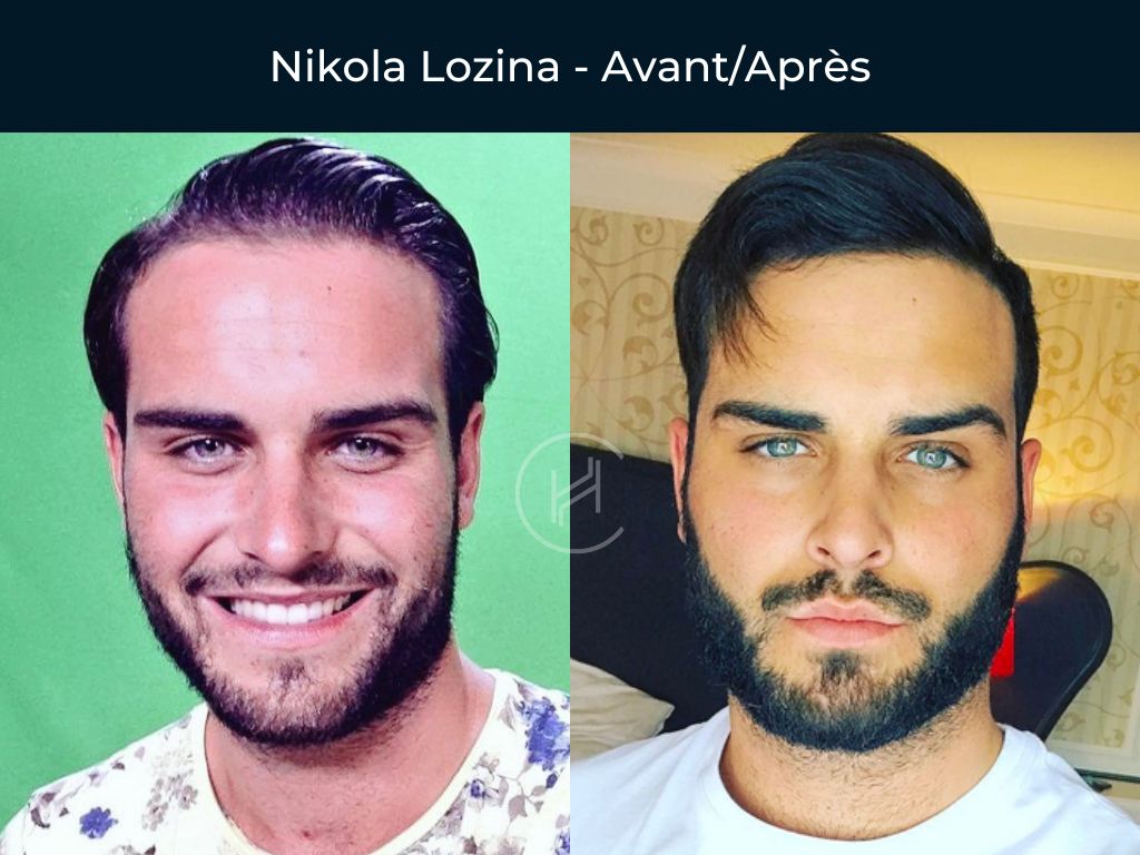 Nikola Lozina-Greffe-de-cheveux-avant-apres Nikola Lozina - Greffe de cheveux avant apres