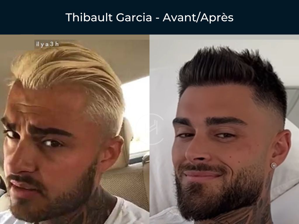 Thibault Garcia - Greffe de cheveux avant apres