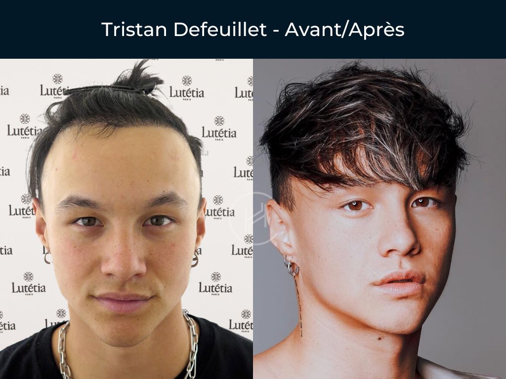 Tristan Defeuillet - Greffe de cheveux avant apres