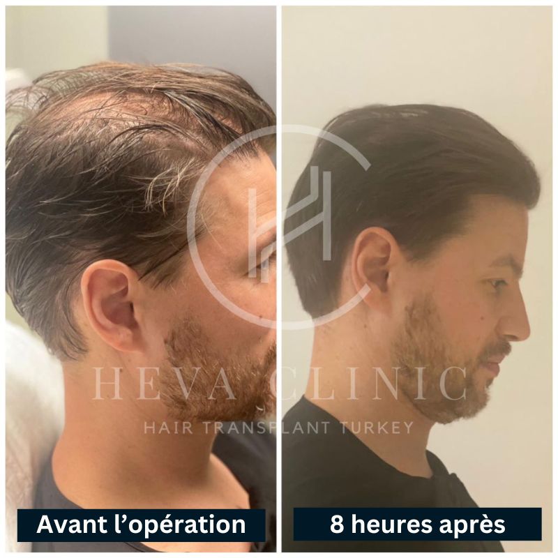 avant et après greffe de cheveux sans le moindre rasage (extraction de cheveux longs)
