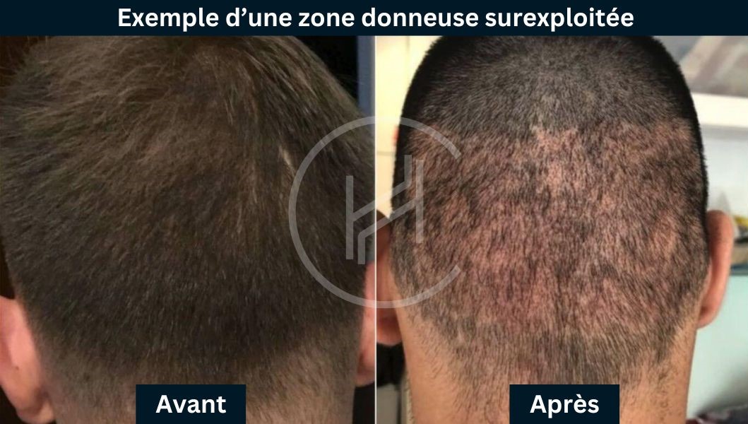 Exemple d’une zone donneuse surexploitée - greffe de cheveux