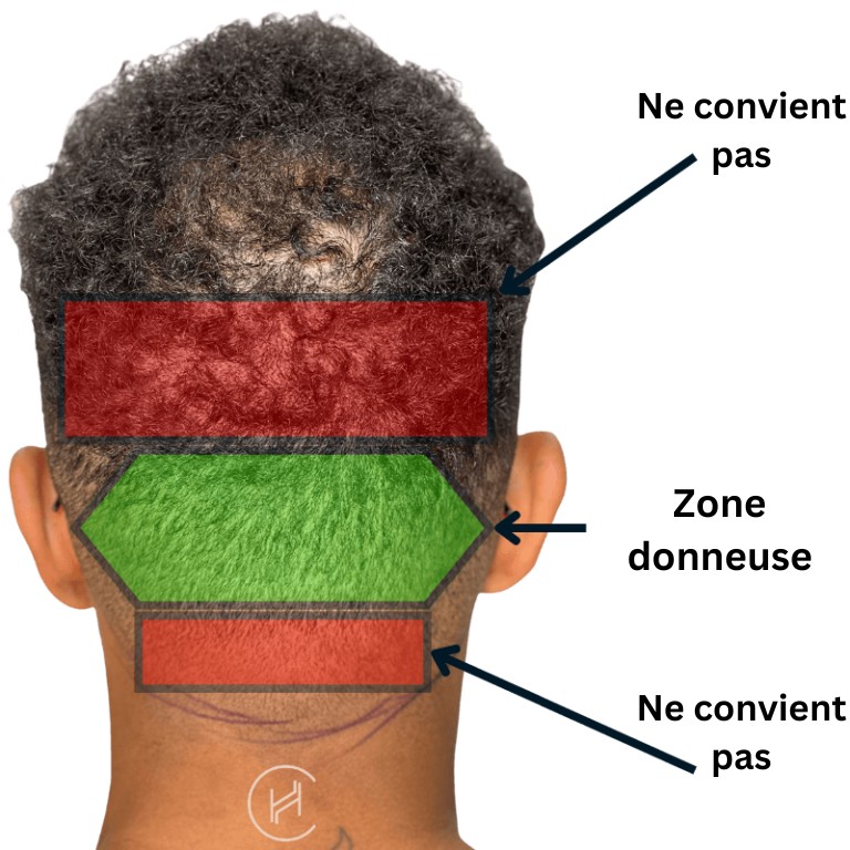 Greffe de cheveux zone donneuse