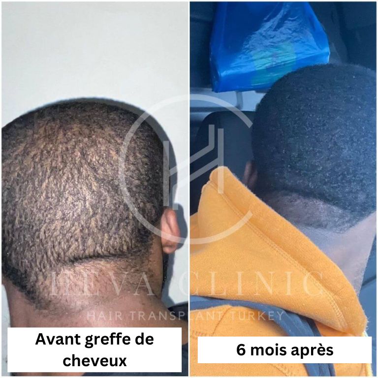 cheveux-donneur-avant-6-mois-après-opération