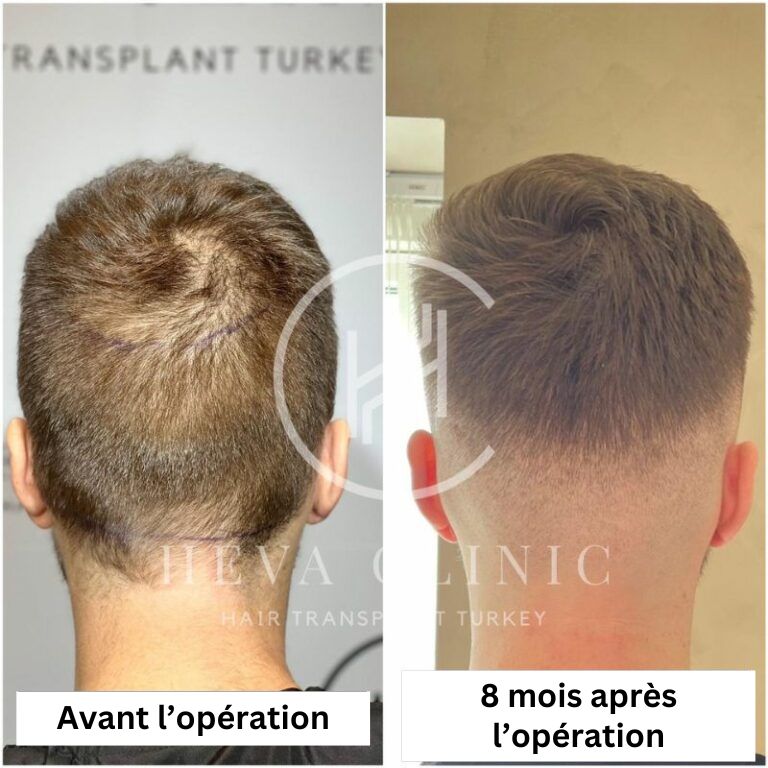 cheveux-donneur-avant-8-mois-après-opération