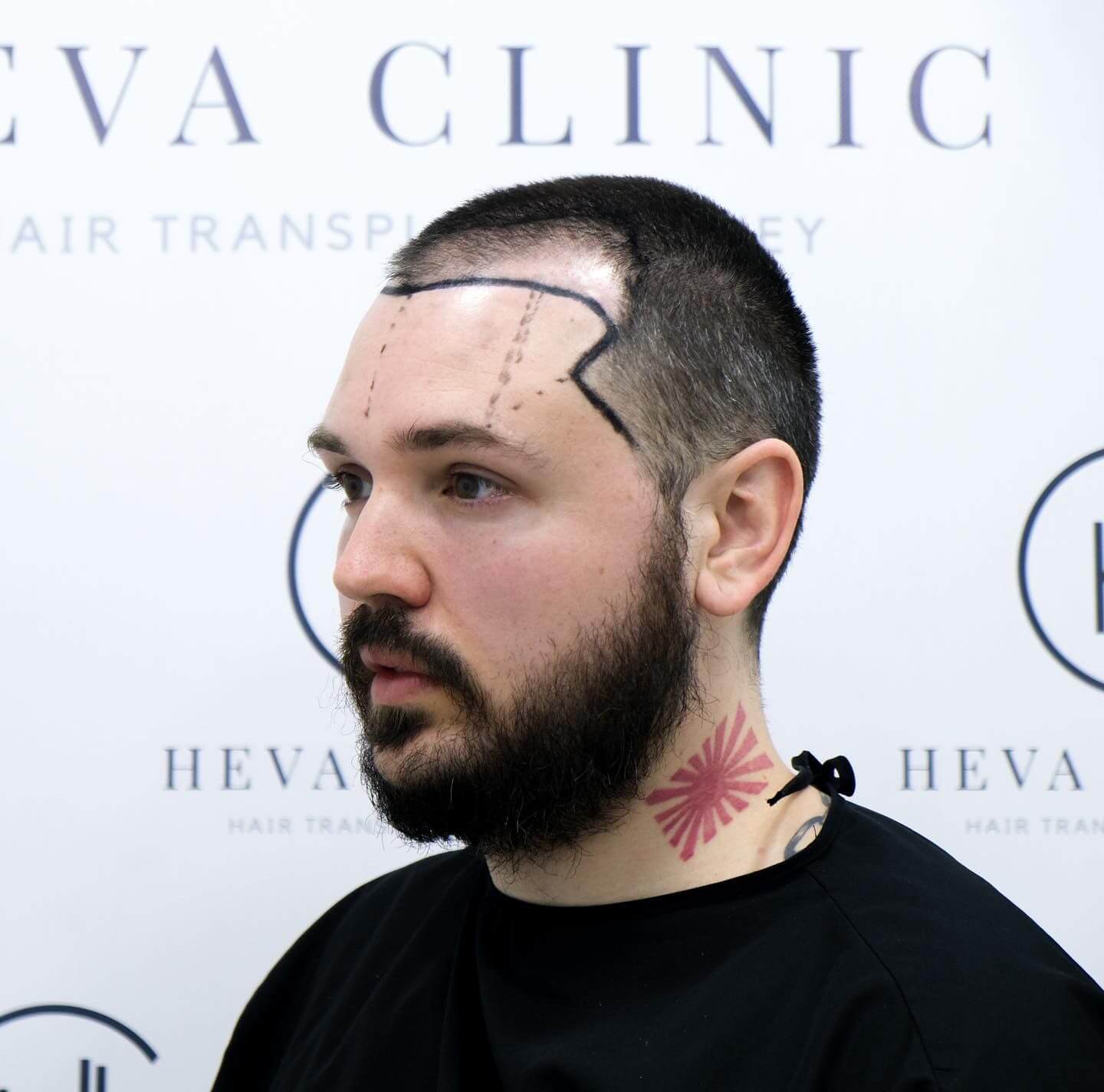 Minoxidil avant et après une greffe de cheveux - Heva Clinic Turquie