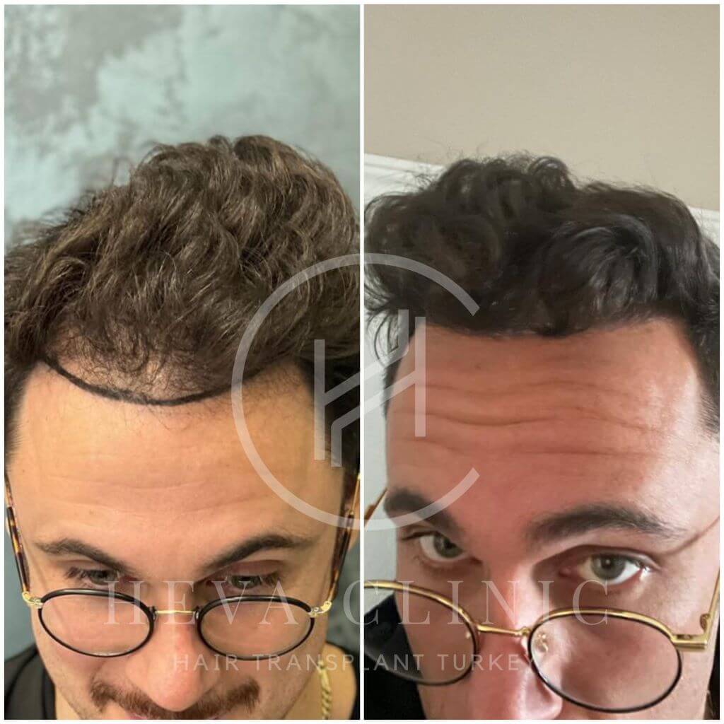 L'opération de greffe de 2500 cheveux - Coûts en 2025
