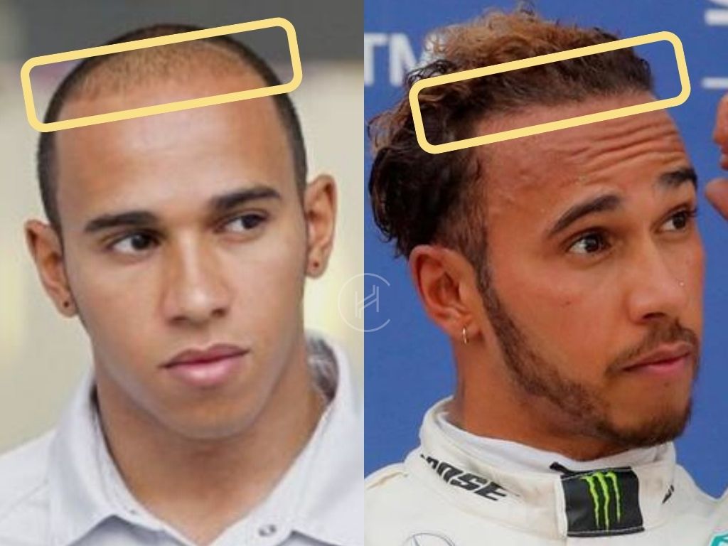 Greffe de cheveux Lewis Hamilton avant et après l'évolution de la racine des cheveux