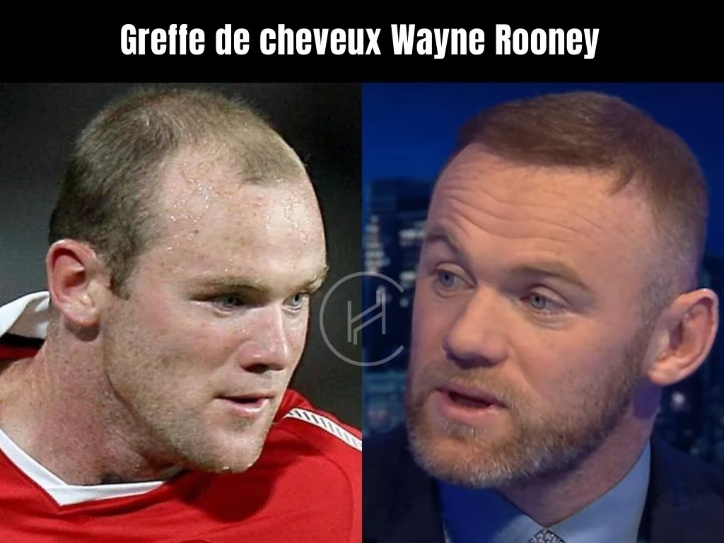 Greffe-de-cheveux-Wayne-Rooney-avant-et-après