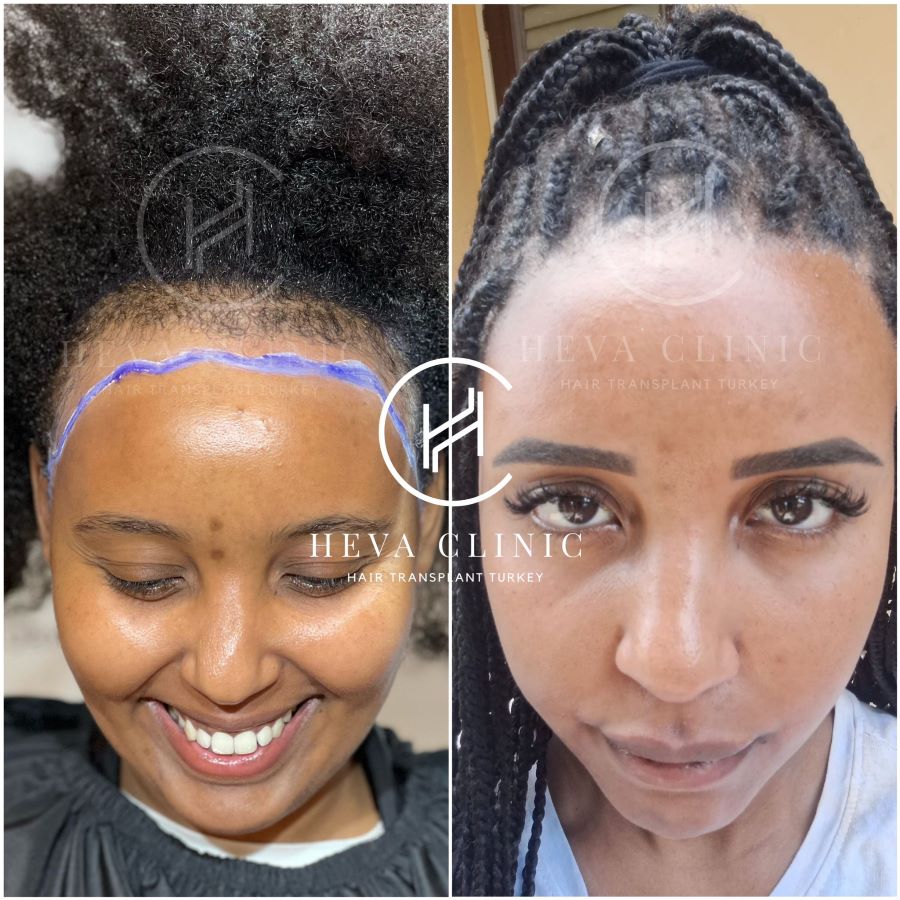Greffe de cheveux afro bouclés féminins avant et après - devant