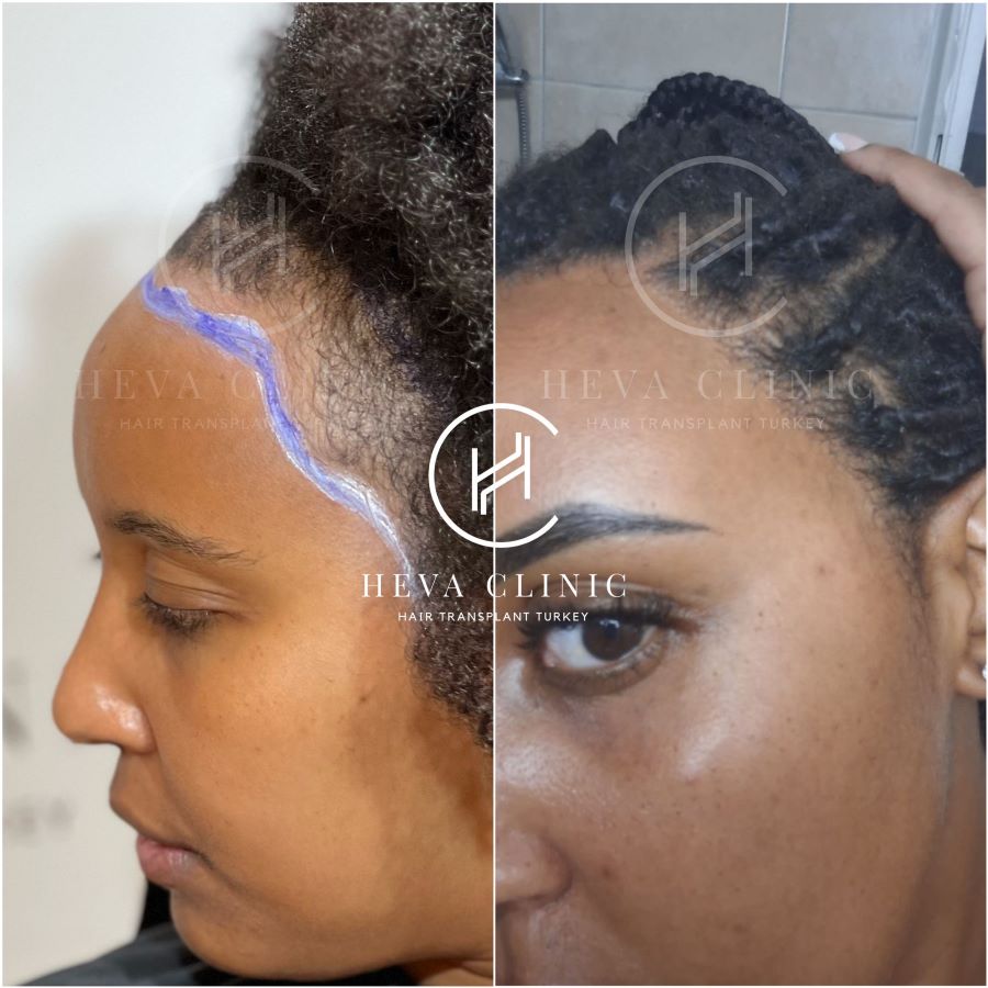 Greffe de cheveux afro bouclés féminins avant et après – tempe gauche