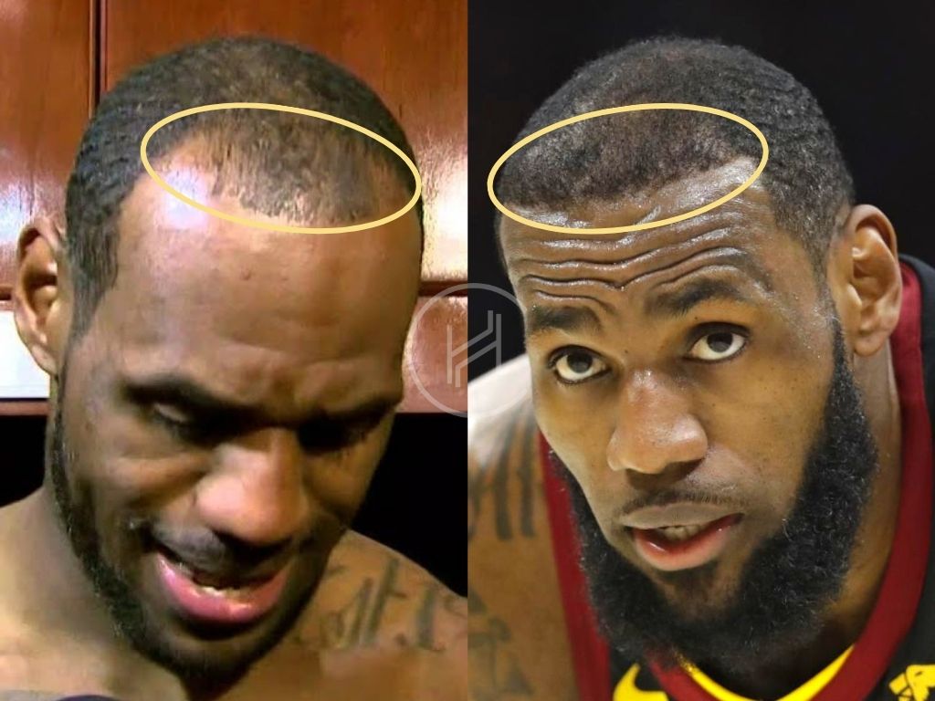 LeBron James - greffe de cheveux avant et après