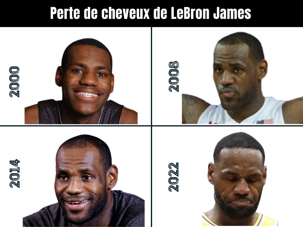 Perte de cheveux de LeBron James