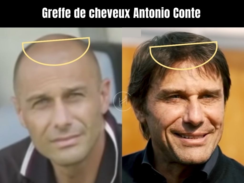 antonio conte avant et après greffe de cheveux