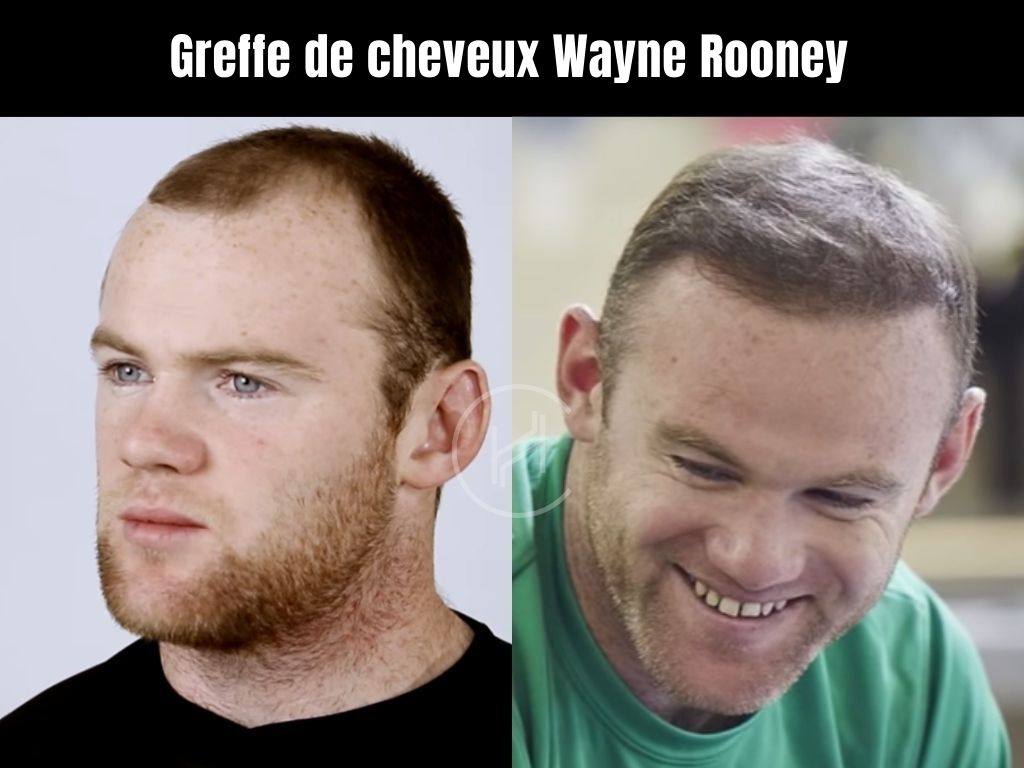 avant-et-après-Greffe-de-cheveux-Wayne-Rooney