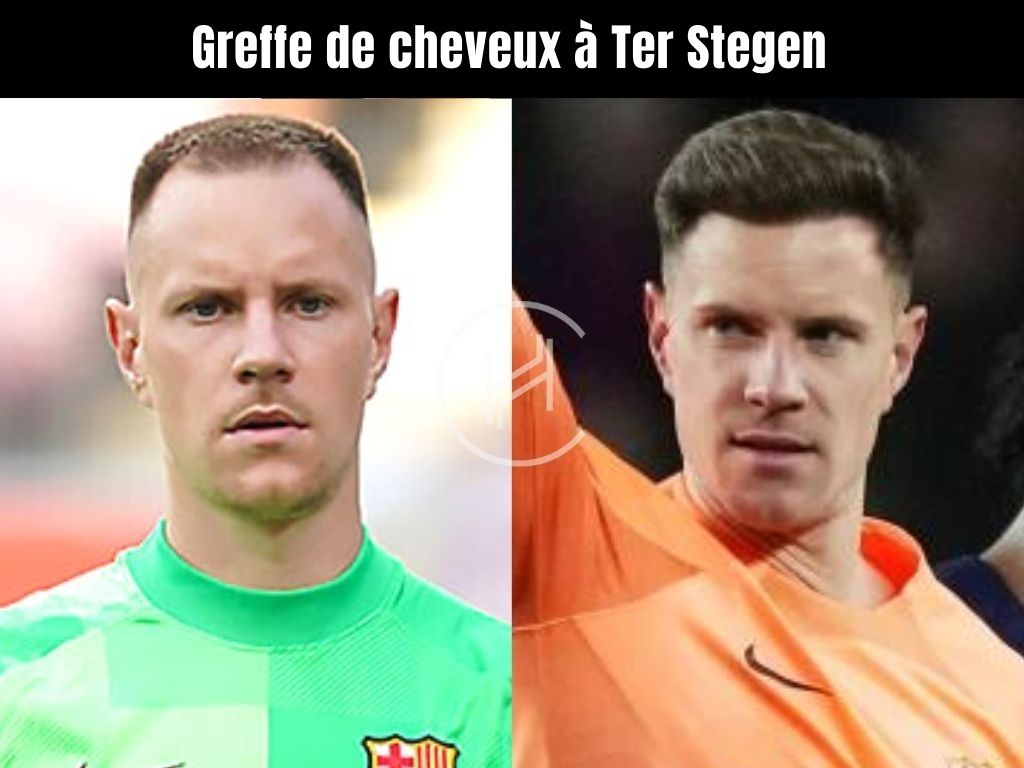 avant & apres Greffe de cheveux à Ter Stegen