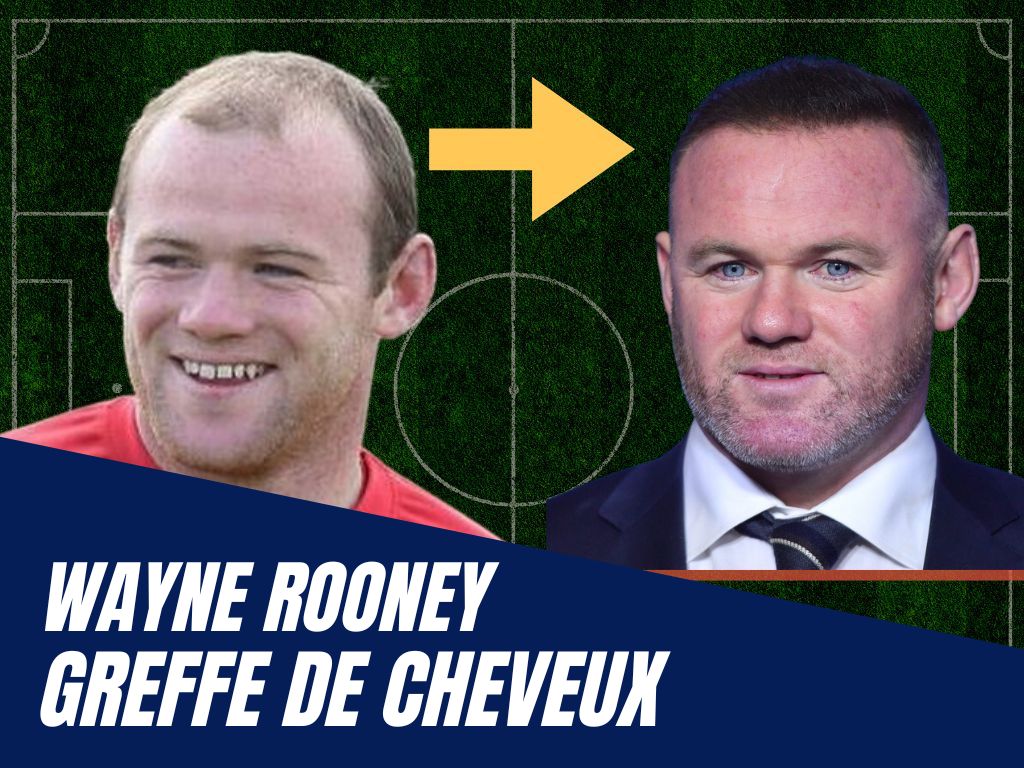 wayne rooney - greffe de cheveux