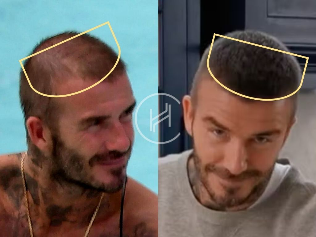 David Beckham - greffe de cheveux avant après