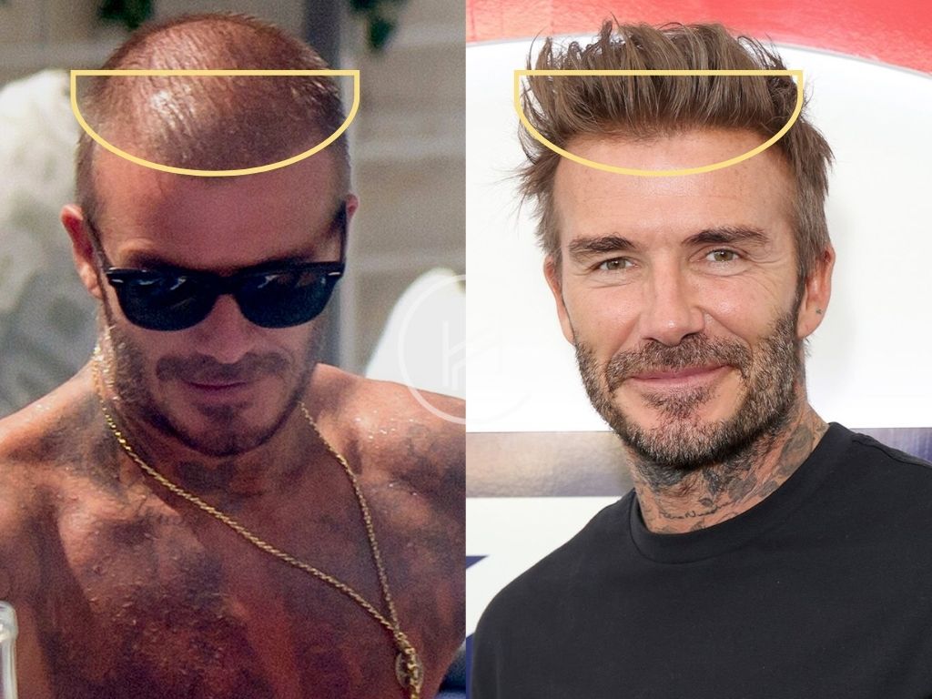 David Beckham - greffe de cheveux photo avant après