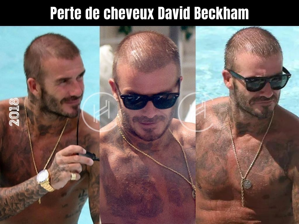 Perte de cheveux David Beckham
