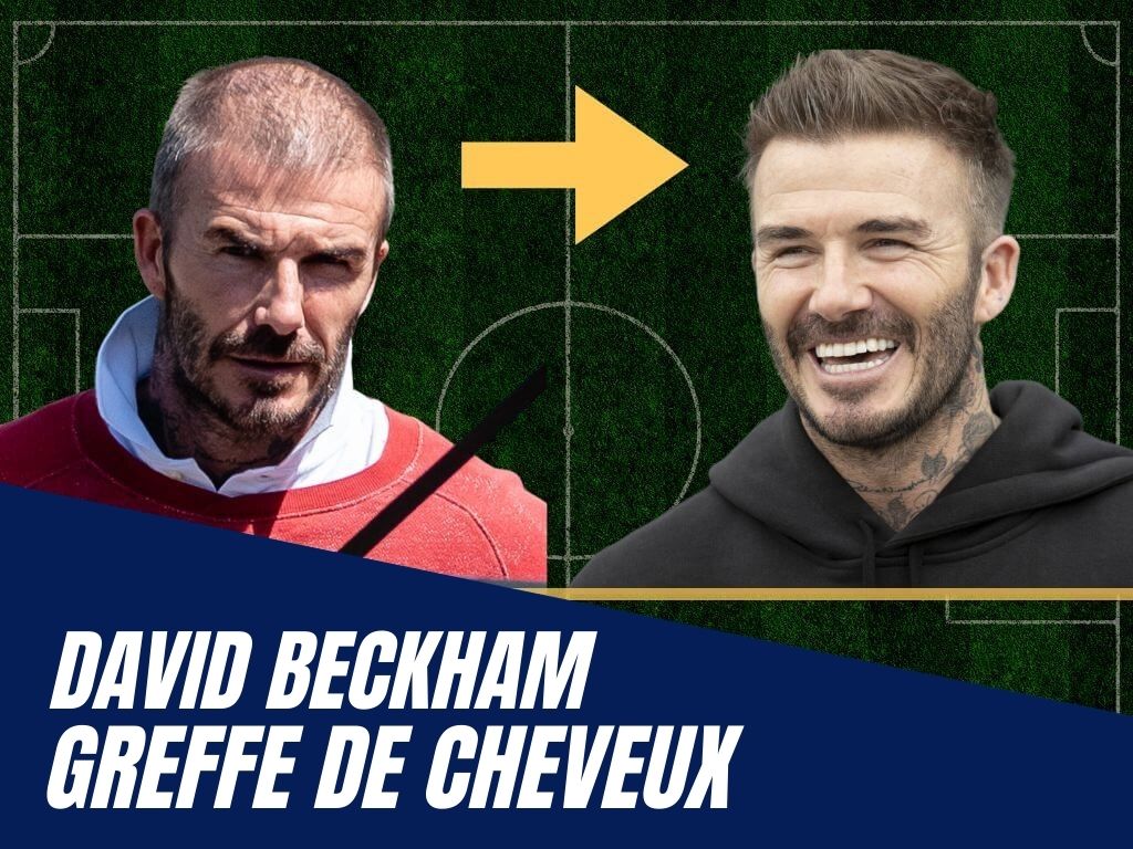 david beckham - greffe de cheveux