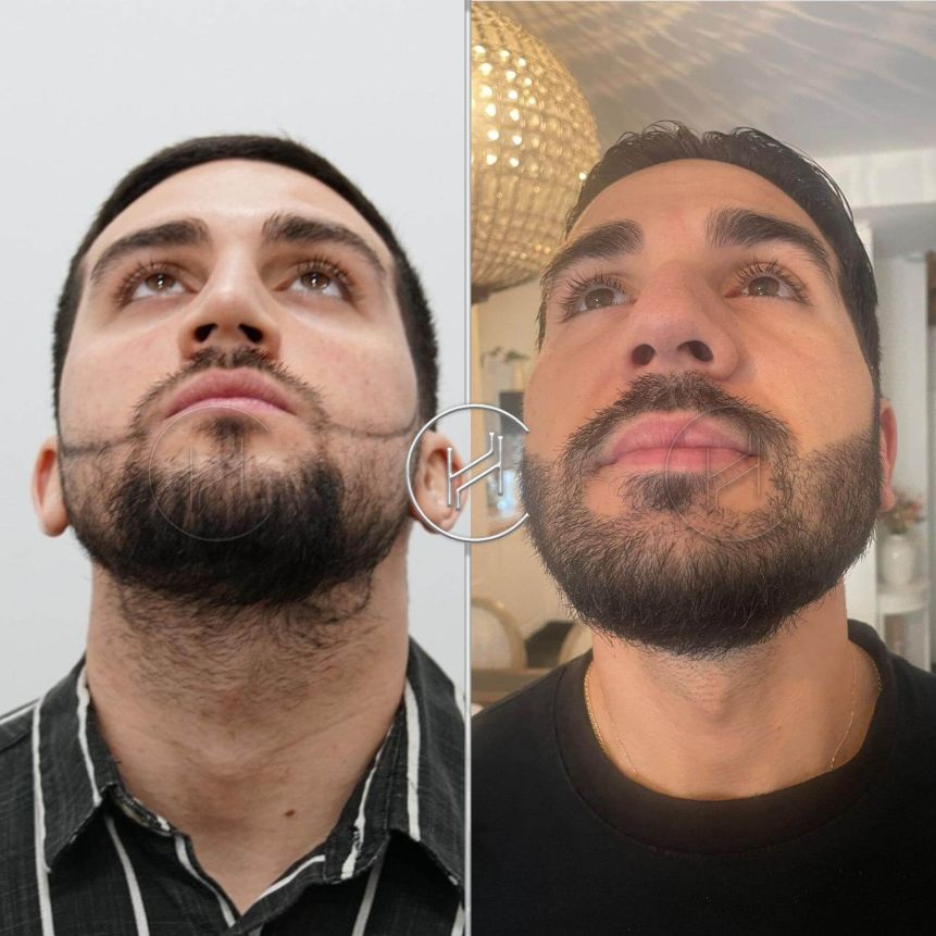 évolution après une greffe de barbe - heva clinic