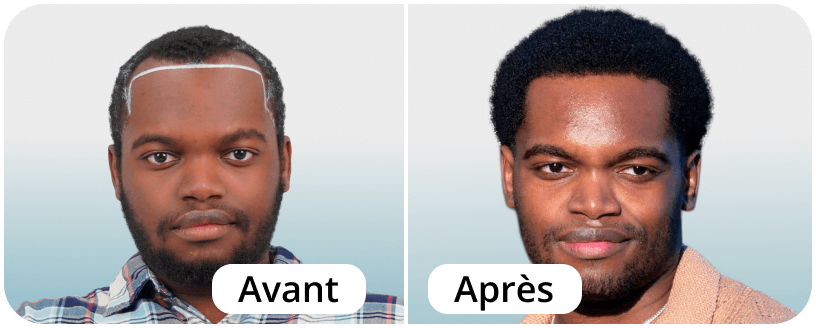 Before-After