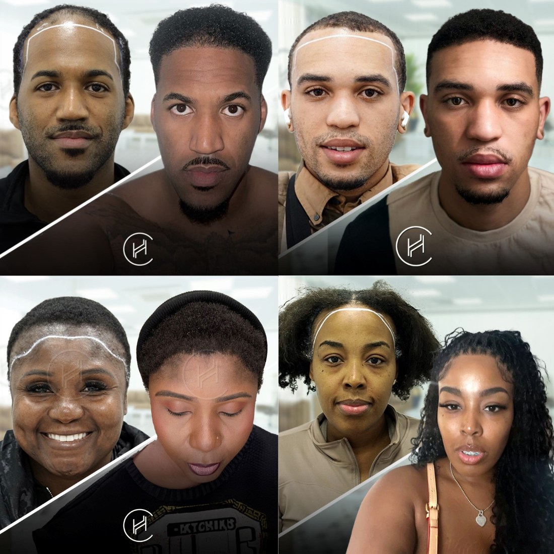 greffe de cheveux afro galerie avant et après