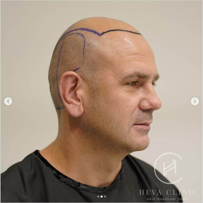 attaccatura dei capelli calva prima del trapianto di capelli nella clinica heva